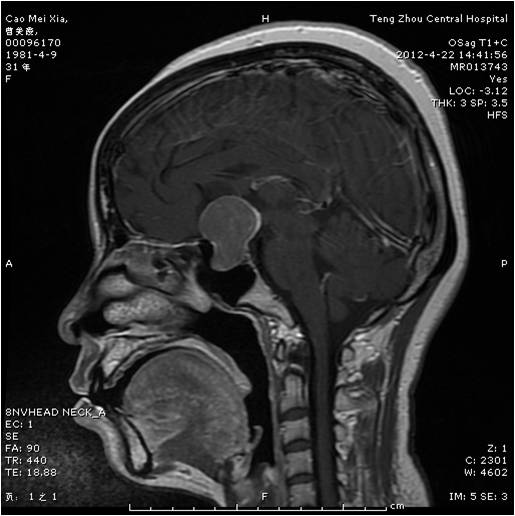 垂體瘤術前.jpg